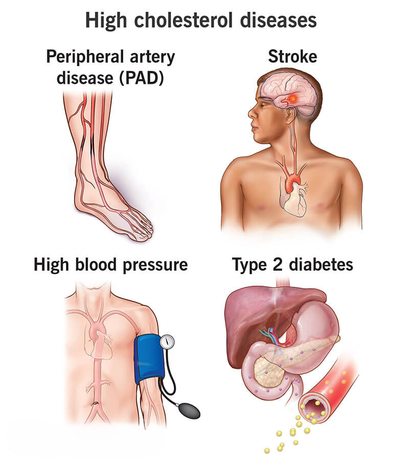 symptoms of high cholesterol