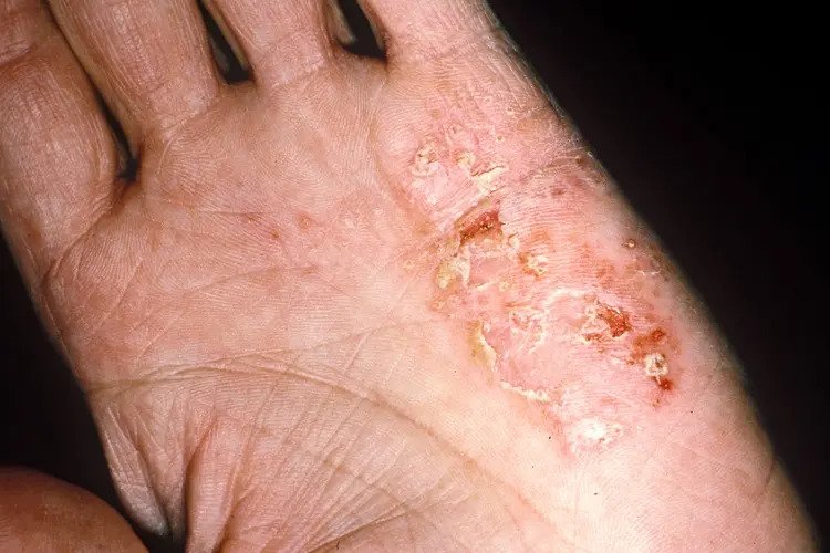 Care for eczema