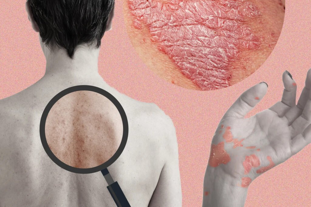 what is eczema
