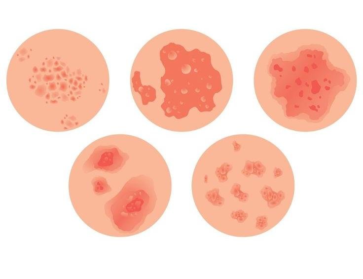 Types of eczema